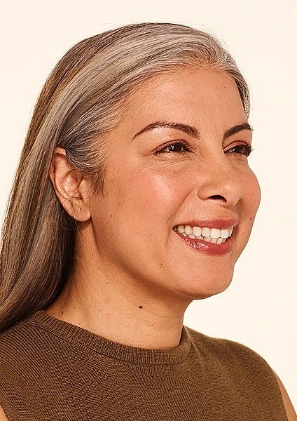 Botox Gallery Before & After