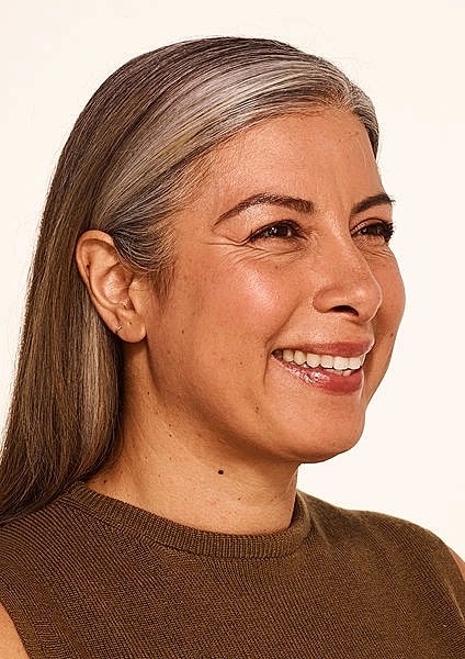 Botox Gallery Before & After