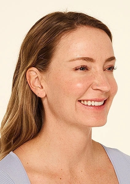 Botox Gallery Before & After