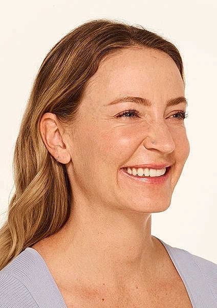 Botox Gallery Before & After