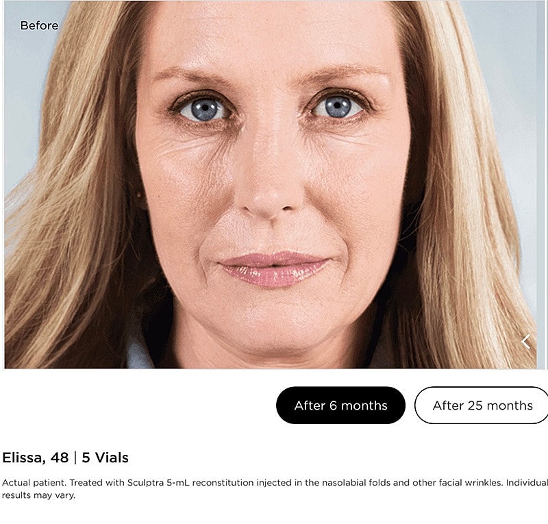 Sculptra Gallery Before & After