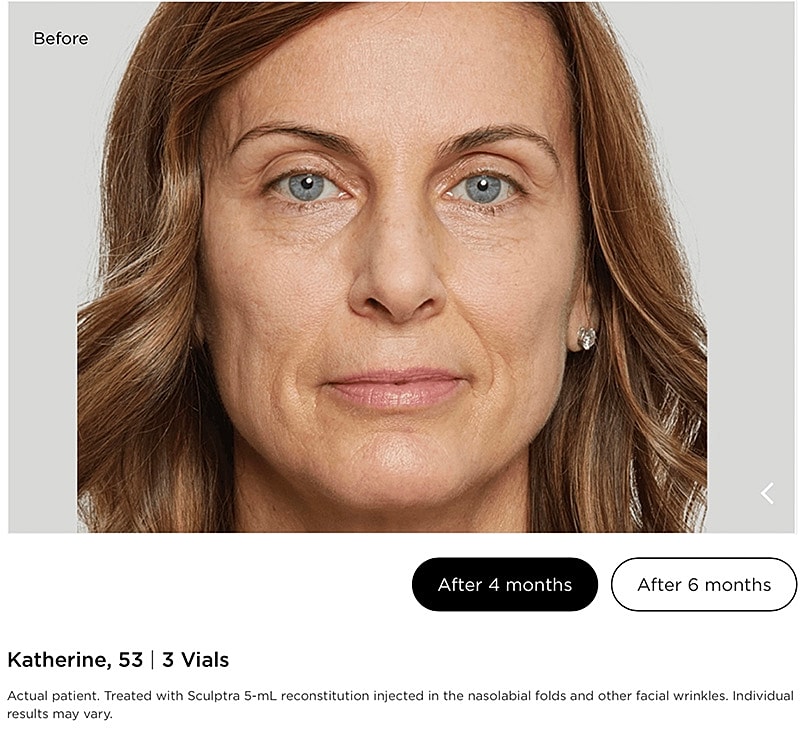 Sculptra Gallery Before & After