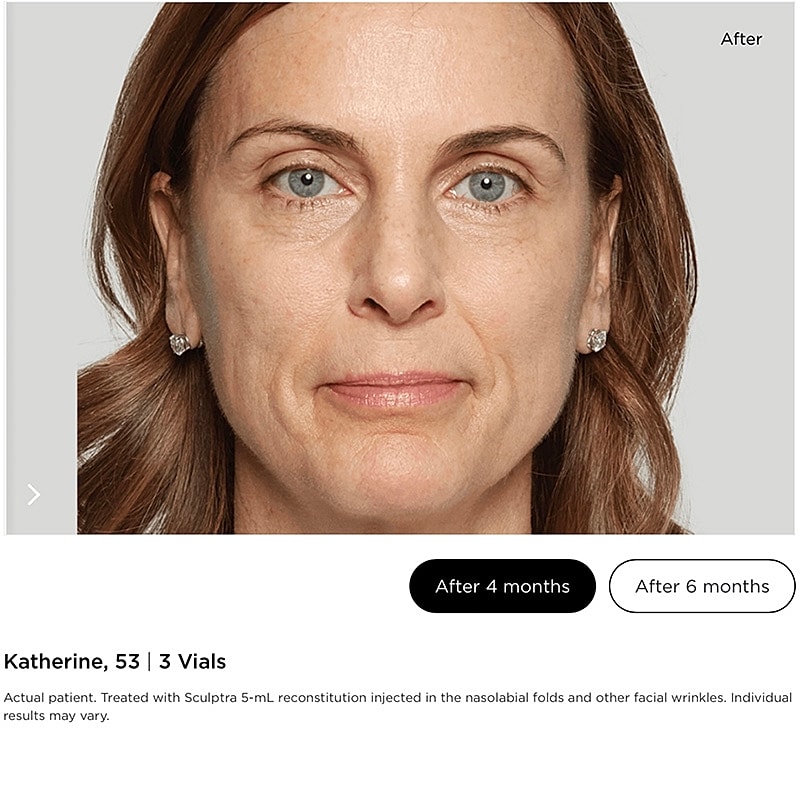 Sculptra Gallery Before & After