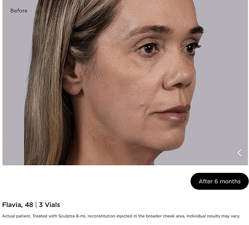 Sculptra Gallery Before & After