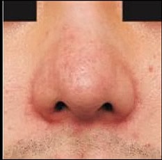 Sylfirm X Gallery Before & After