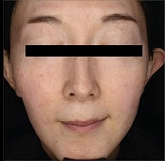 Sylfirm X Gallery Before & After