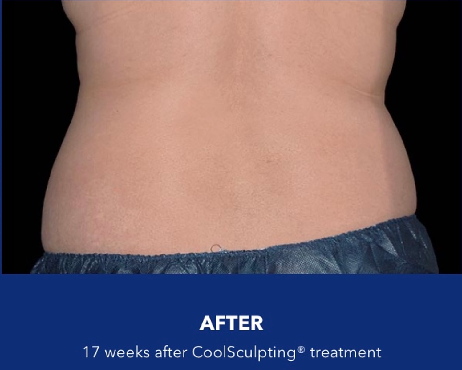 CoolSculpting Gallery Before & After