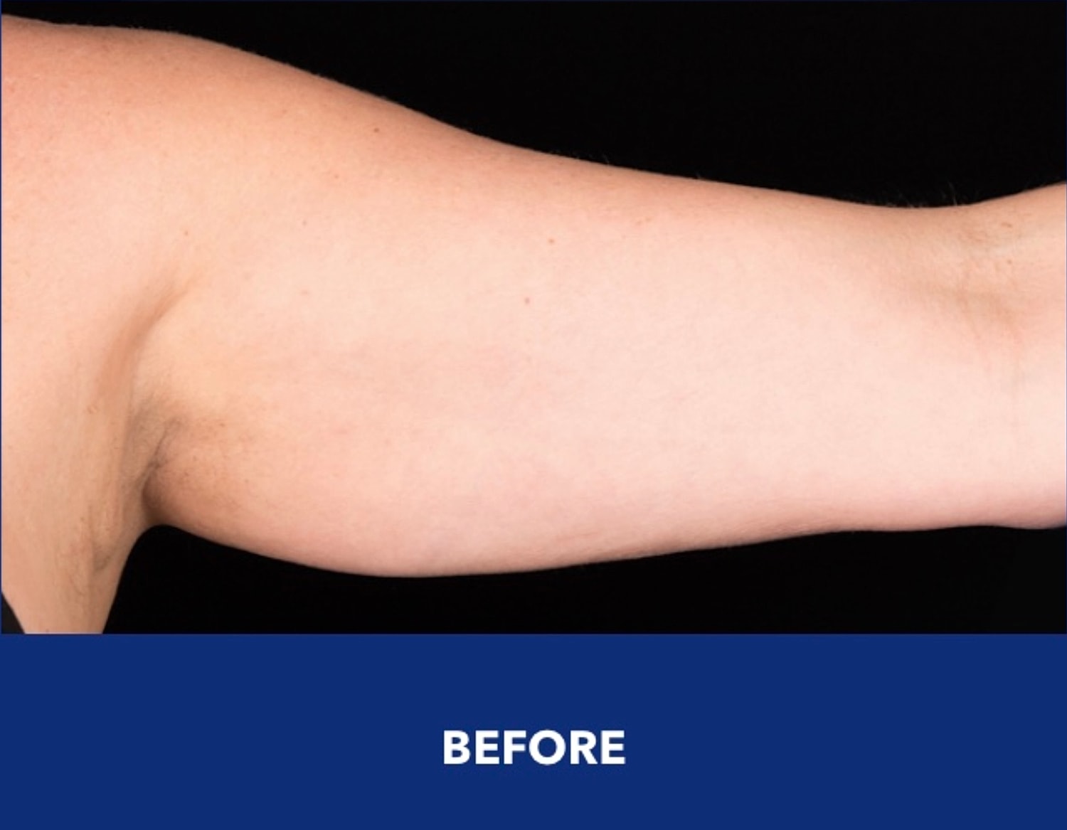 CoolSculpting Gallery Before & After