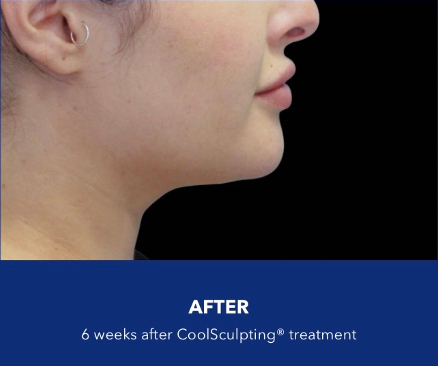 CoolSculpting Gallery Before & After