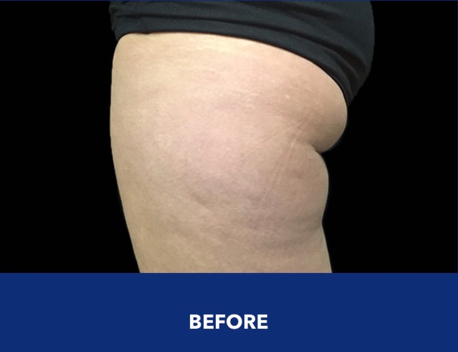CoolSculpting Gallery Before & After