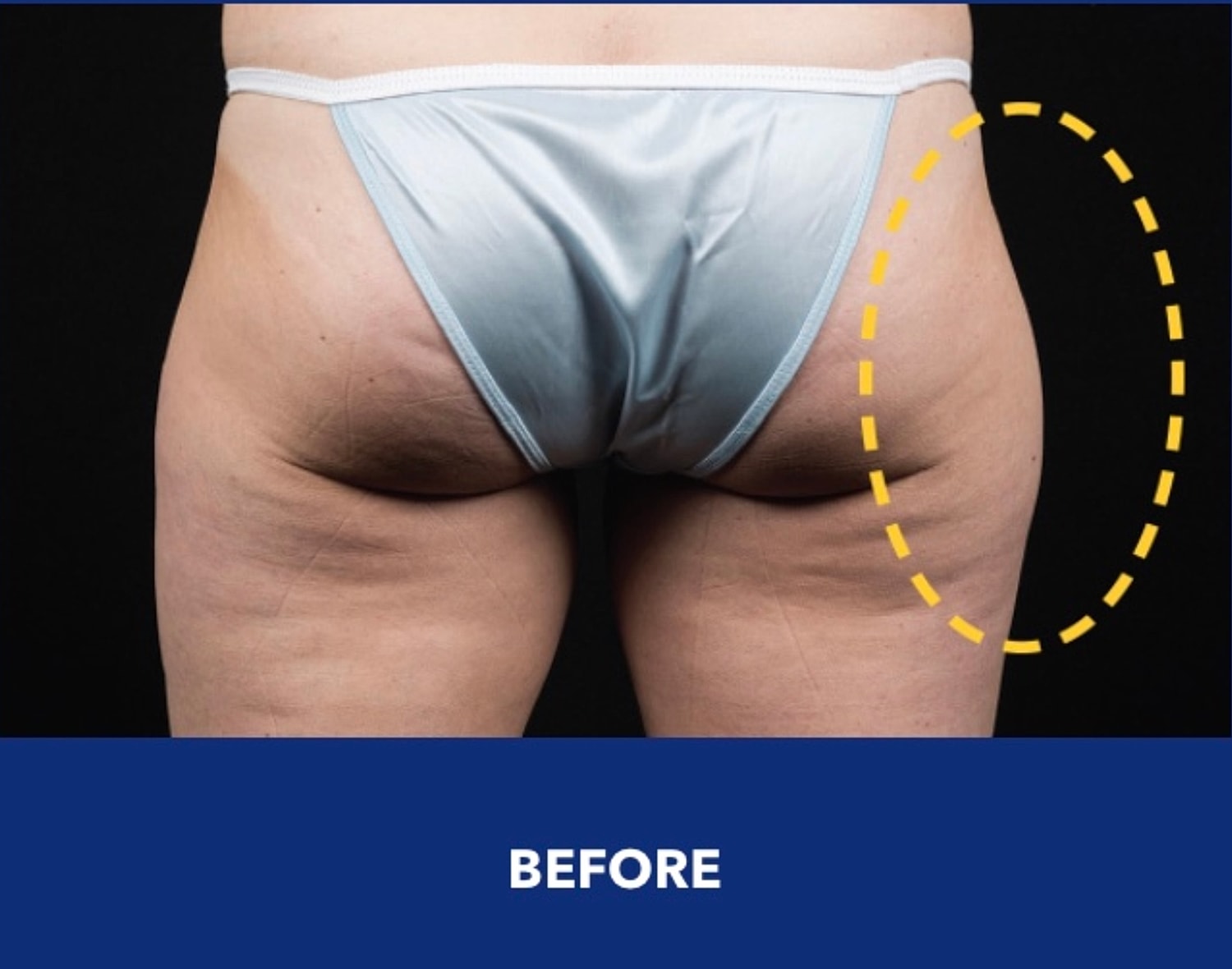CoolSculpting Gallery Before & After