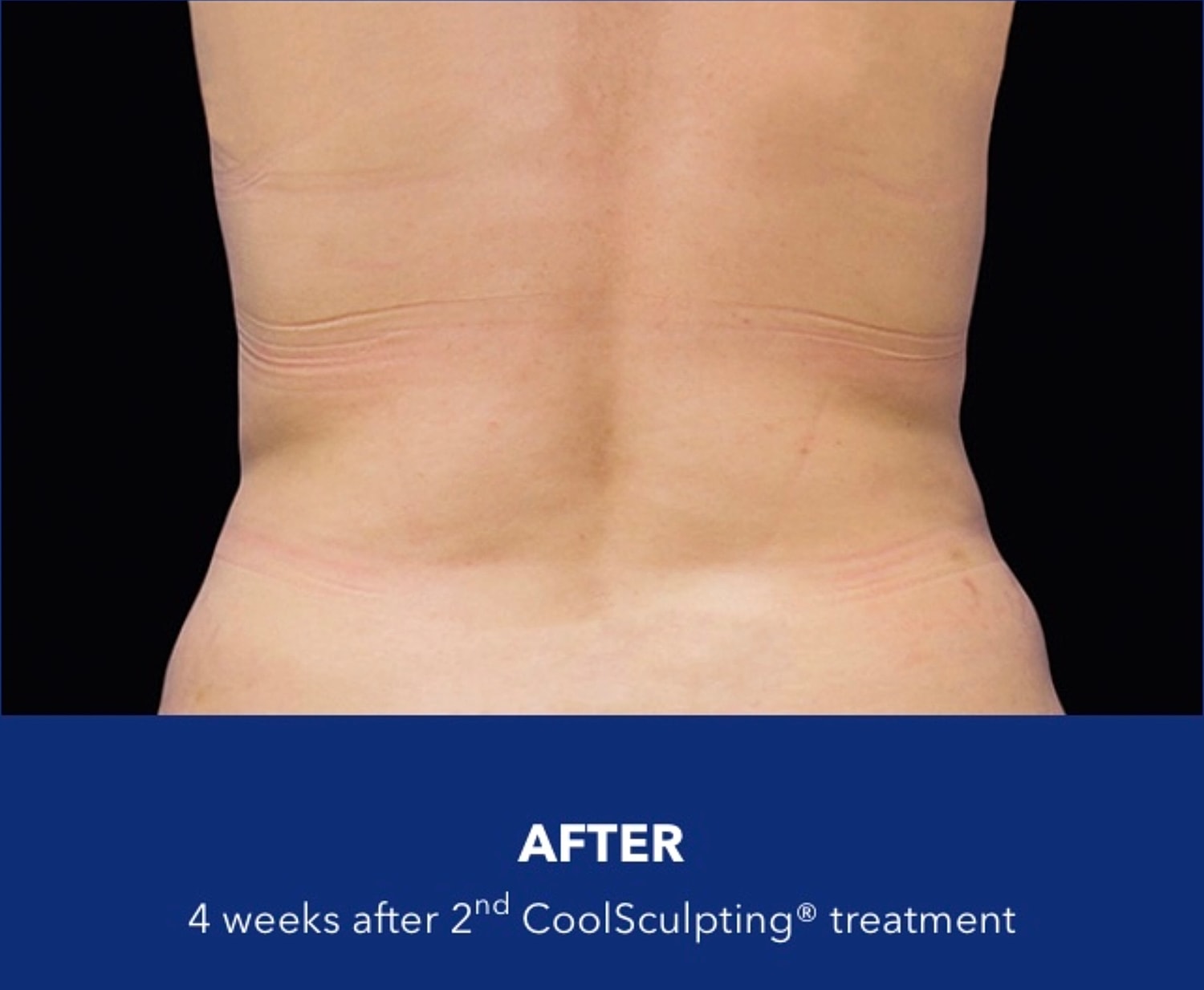 CoolSculpting Gallery Before & After