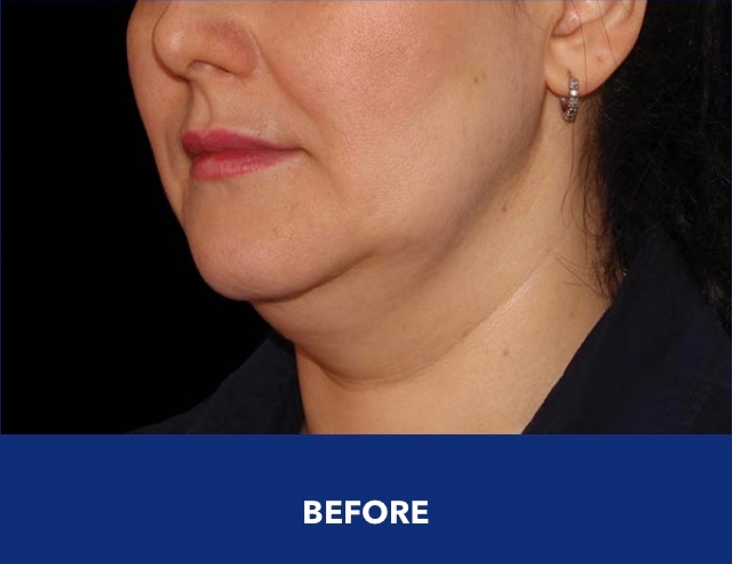 CoolSculpting Gallery Before & After