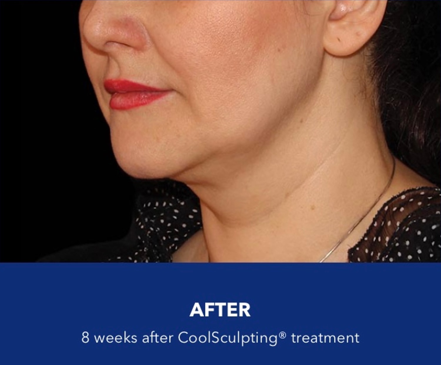 CoolSculpting Gallery Before & After