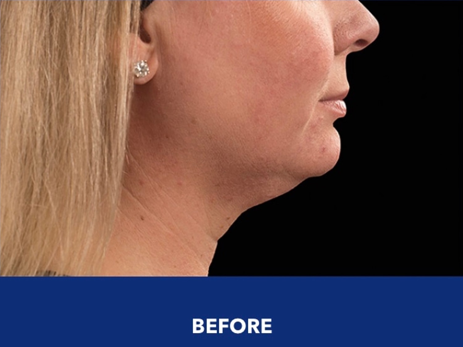 CoolSculpting Gallery Before & After