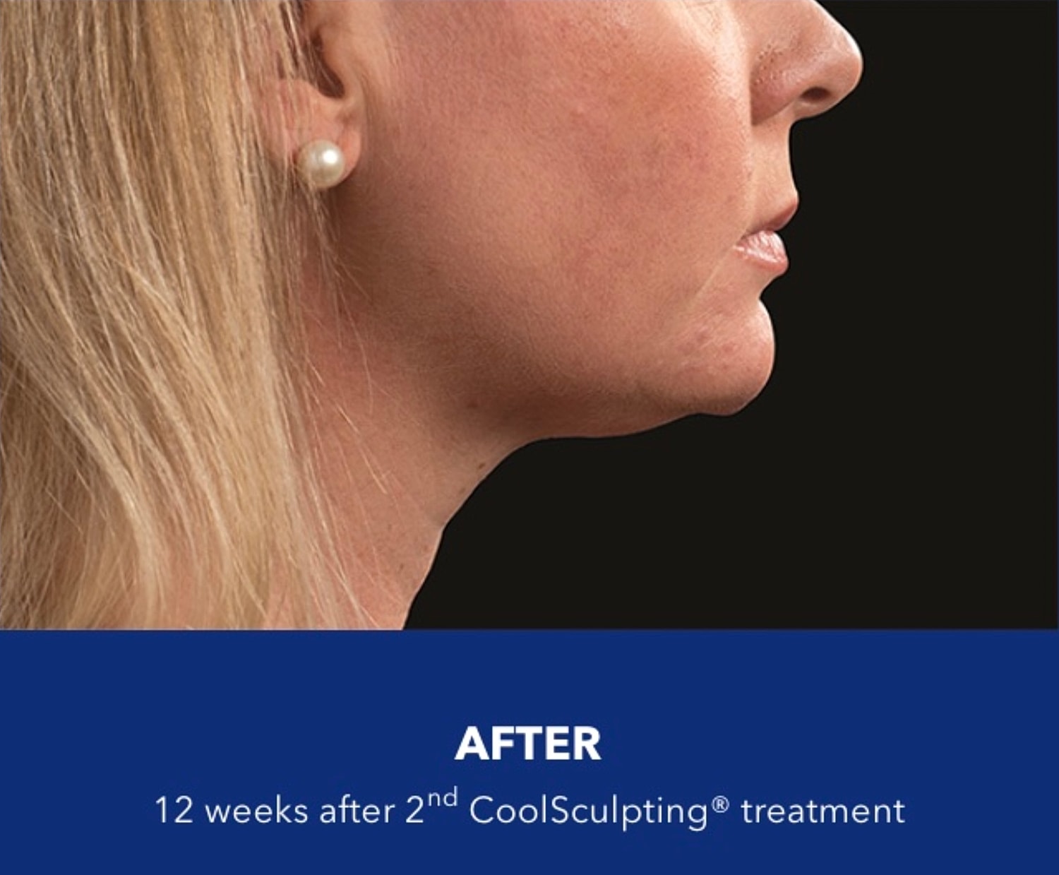 CoolSculpting Gallery Before & After