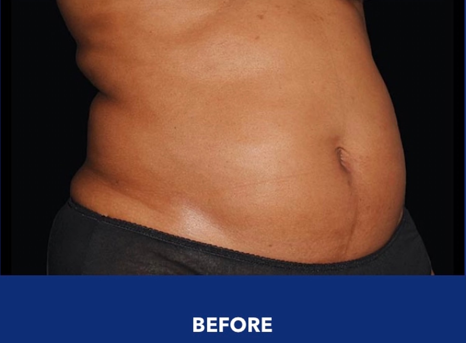 CoolSculpting Gallery Before & After