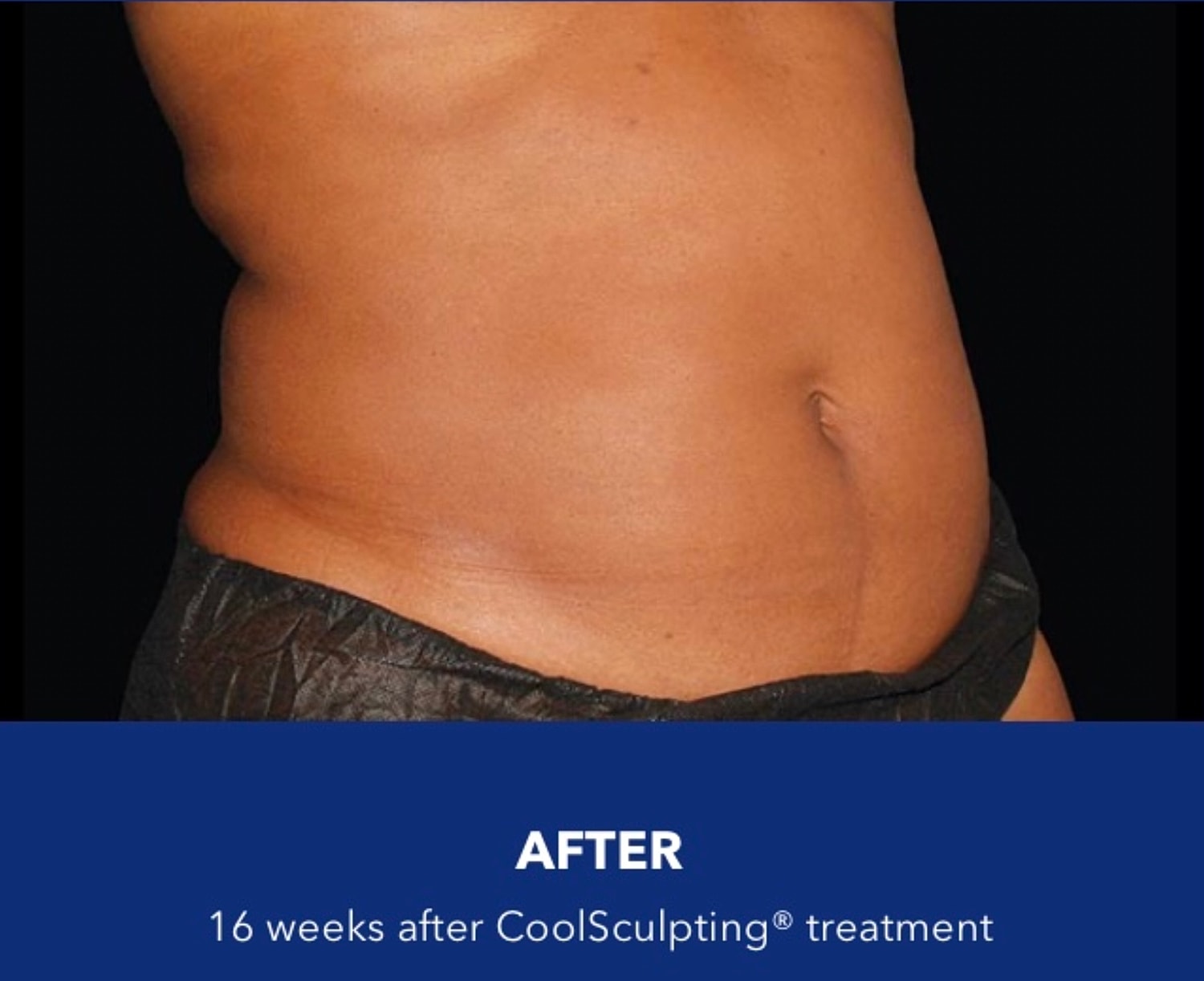 CoolSculpting Gallery Before & After