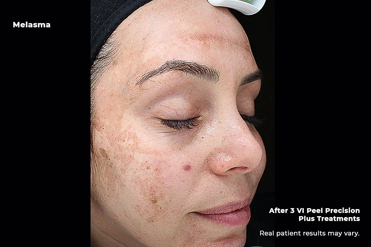 Vi Peel Gallery Before & After