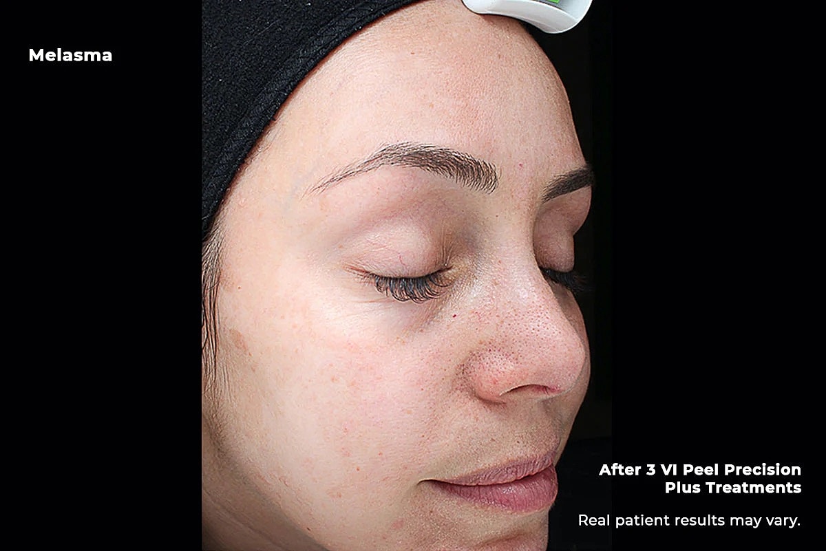 Vi Peel Gallery Before & After