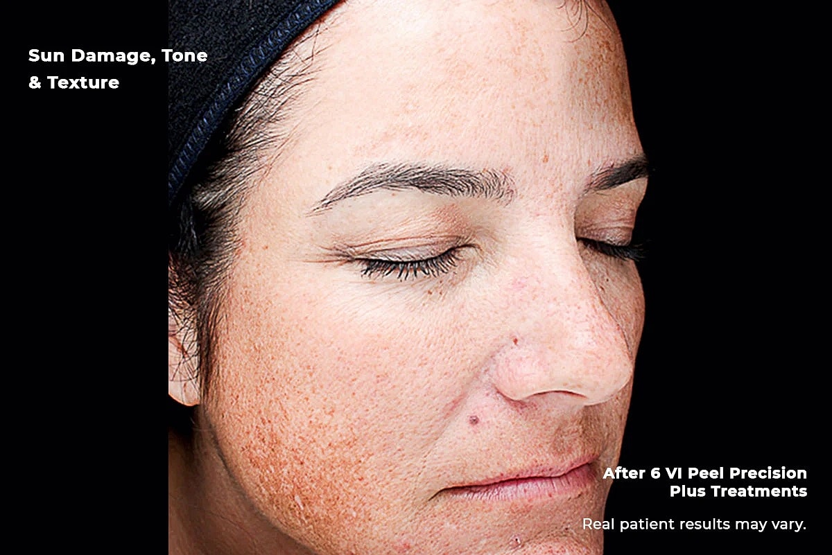 Vi Peel Gallery Before & After