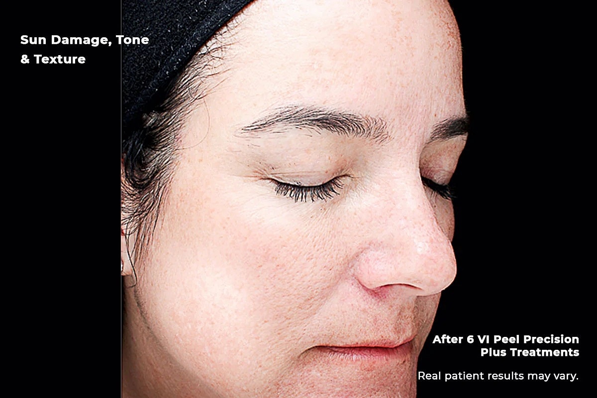 Vi Peel Gallery Before & After