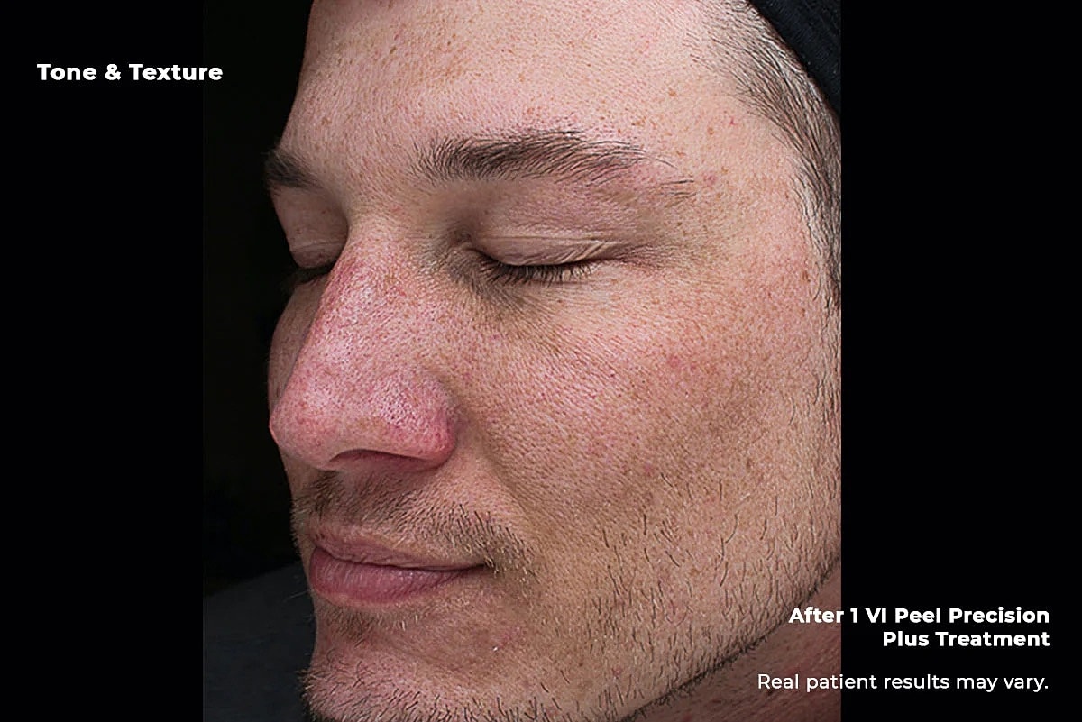 Vi Peel Gallery Before & After