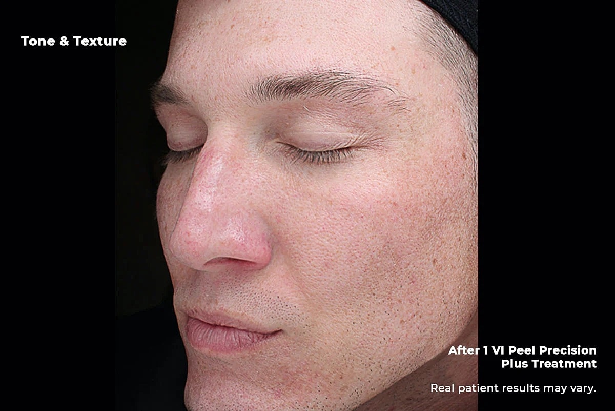 Vi Peel Gallery Before & After