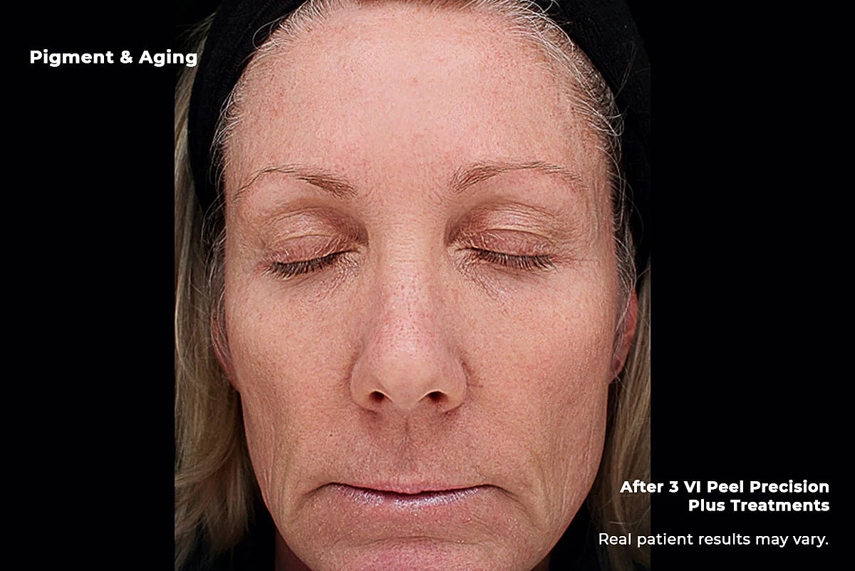 Vi Peel Gallery Before & After