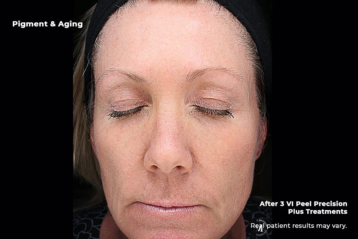 Vi Peel Gallery Before & After