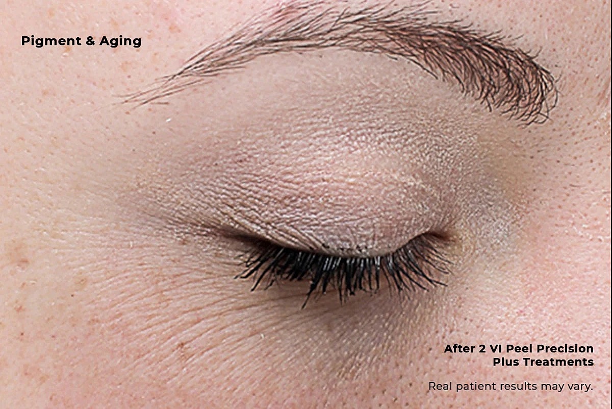 Vi Peel Gallery Before & After