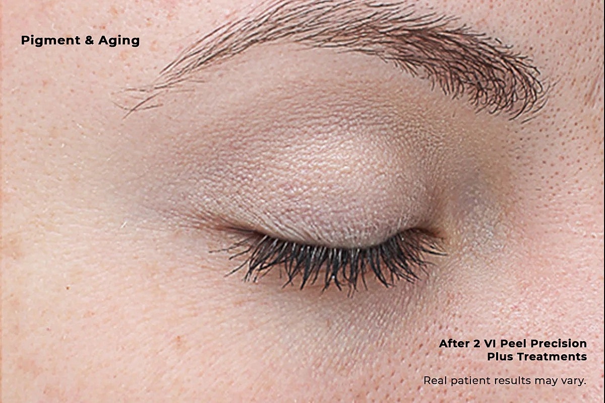 Vi Peel Gallery Before & After