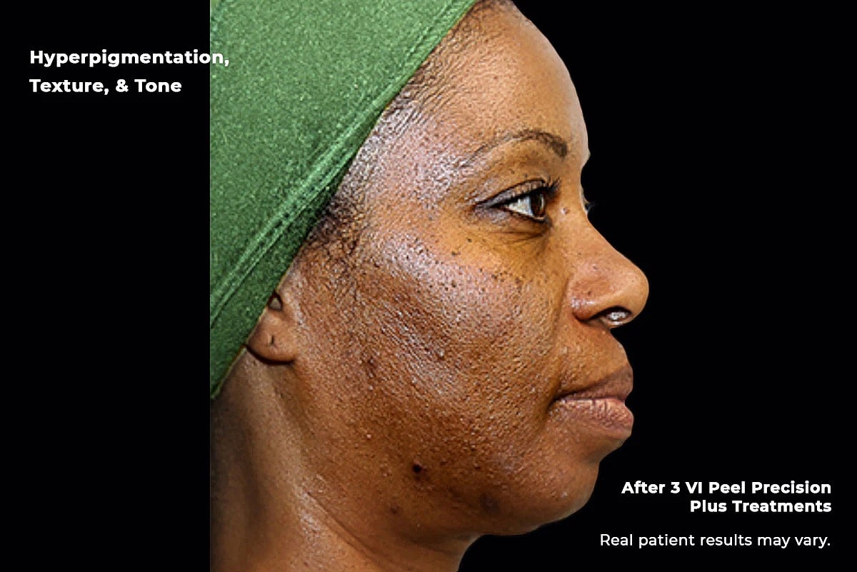 Vi Peel Gallery Before & After