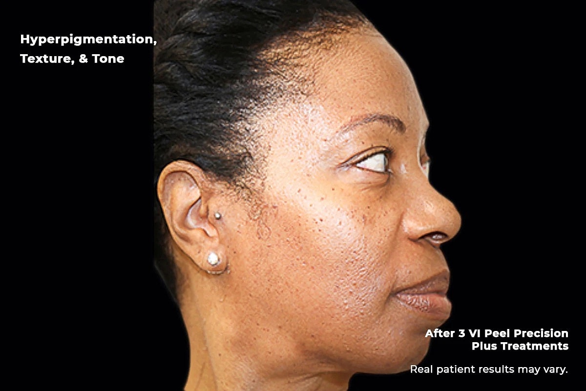 Vi Peel Gallery Before & After