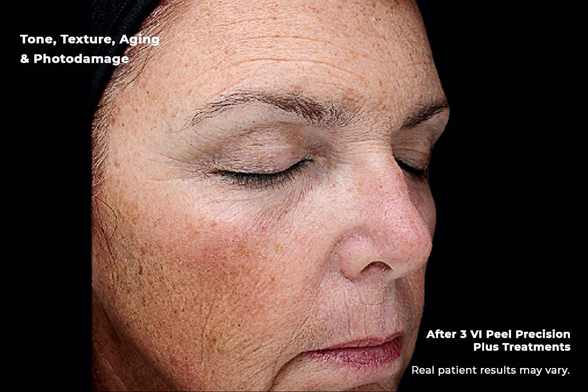 Vi Peel Gallery Before & After