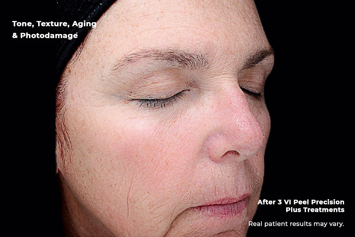 Vi Peel Gallery Before & After