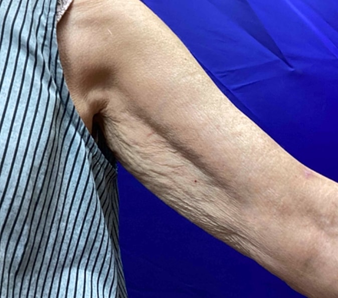 Sofwave Gallery Before & After