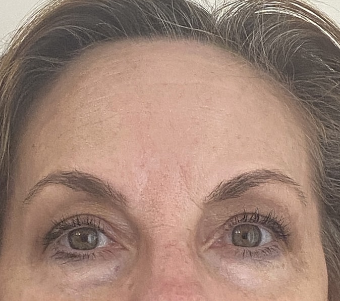 Sofwave Gallery Before & After