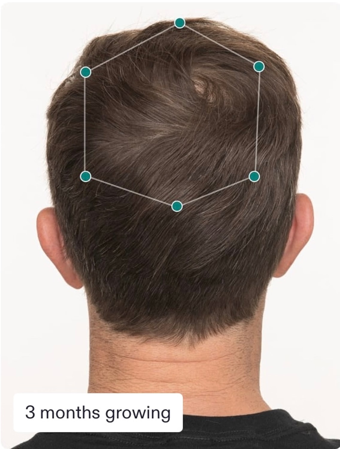 Nutrafol Gallery Before & After