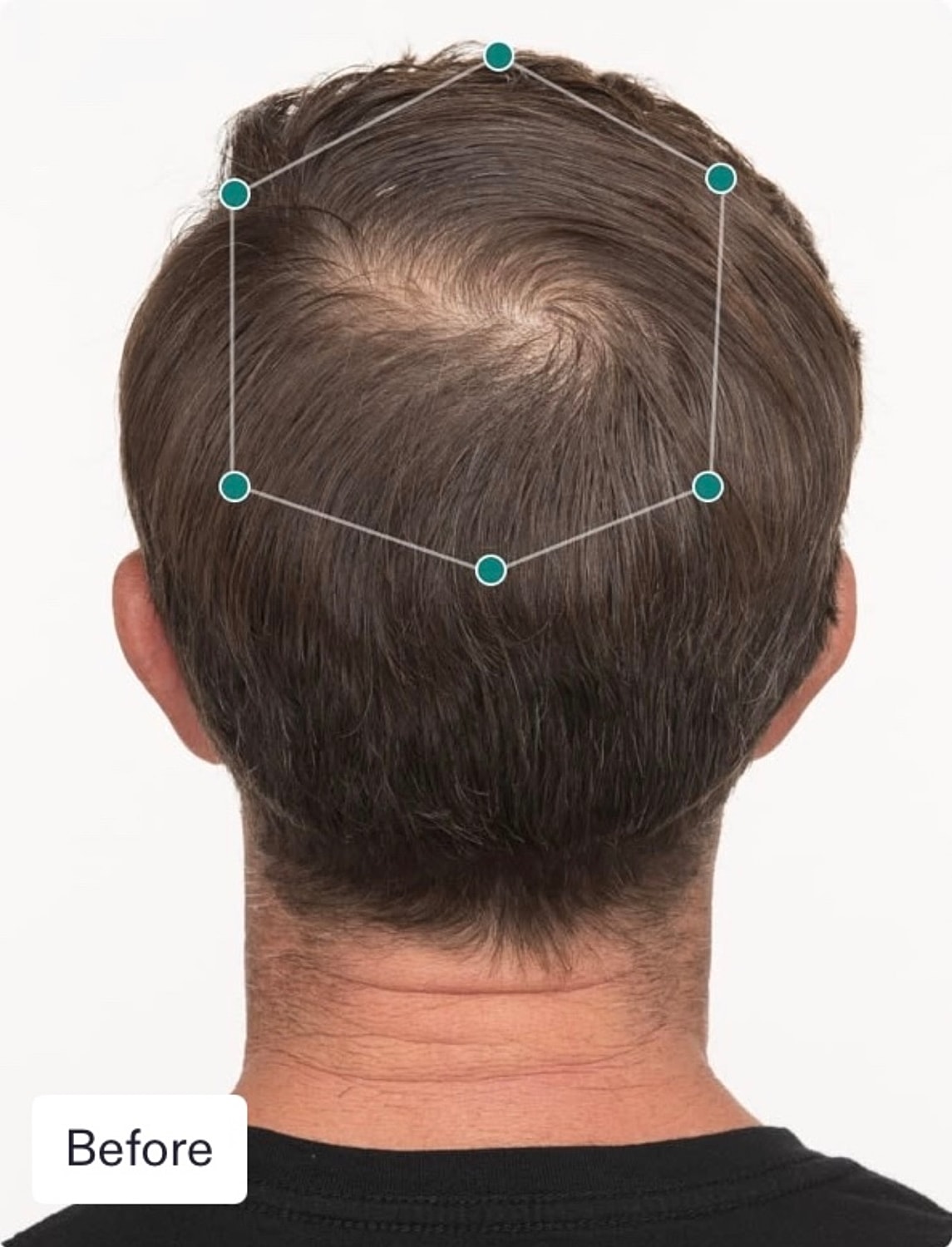 Nutrafol Gallery Before & After