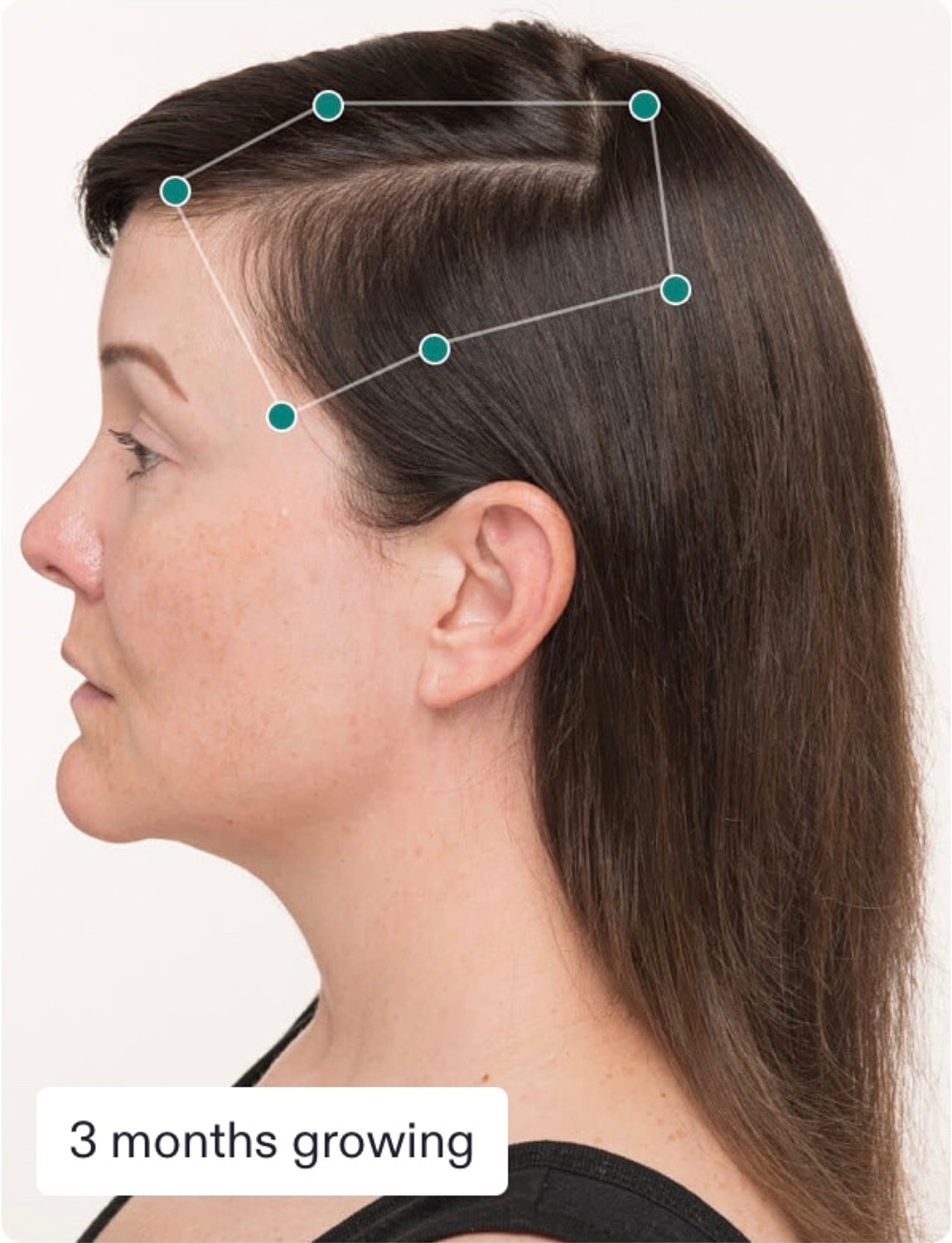 Nutrafol Gallery Before & After