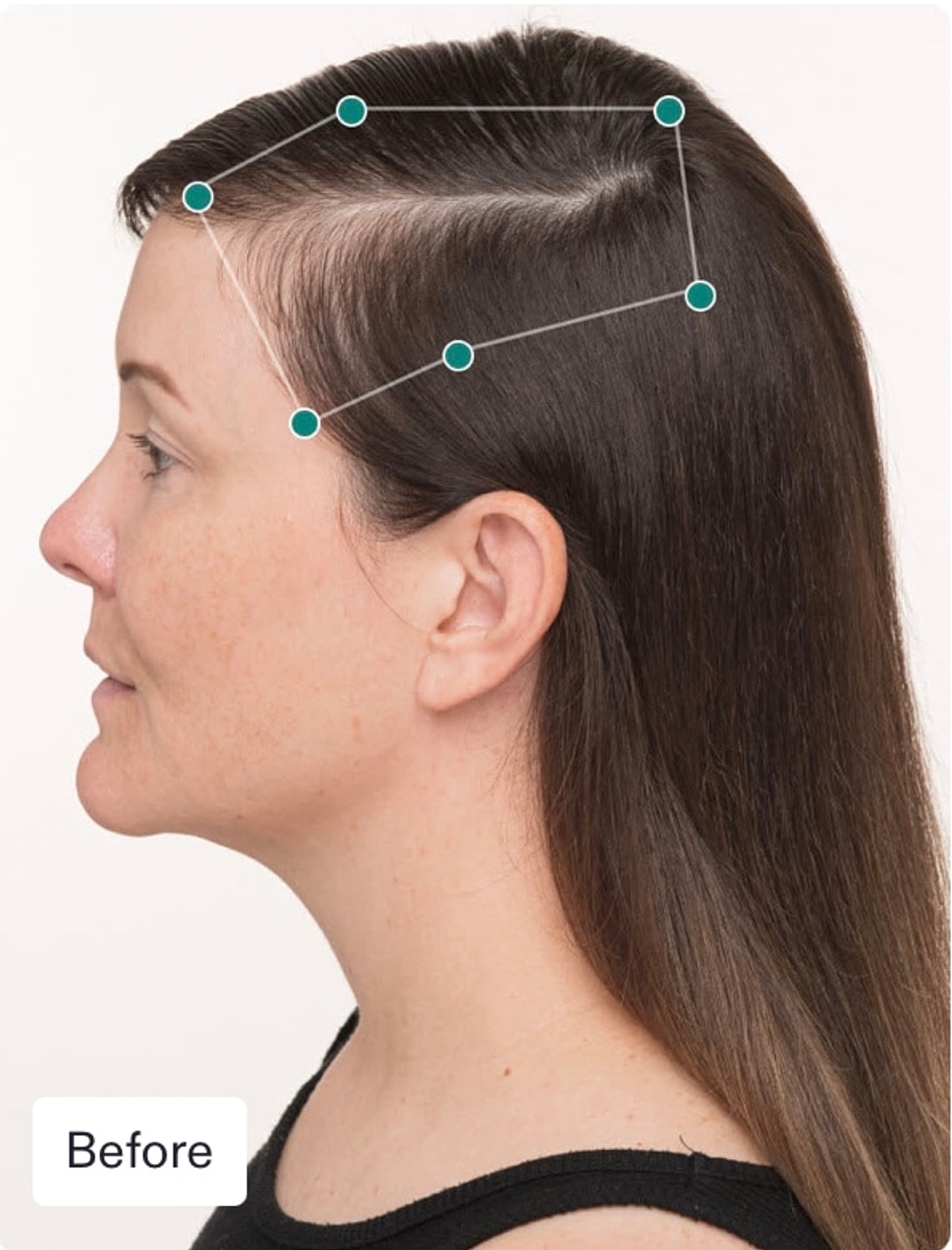 Nutrafol Gallery Before & After