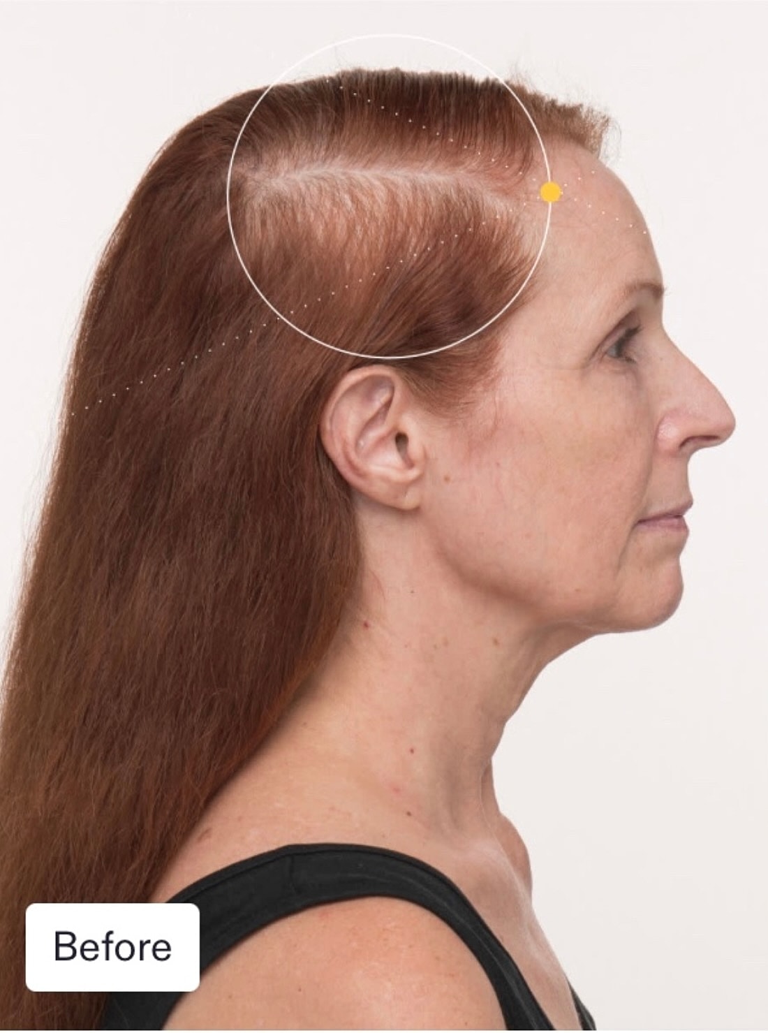 Nutrafol Gallery Before & After