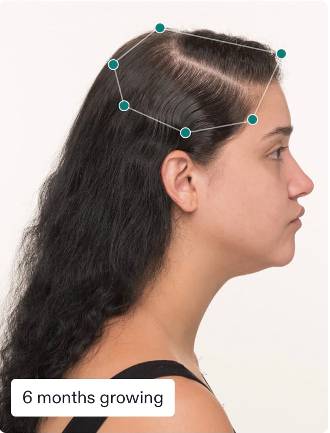 Nutrafol Gallery Before & After